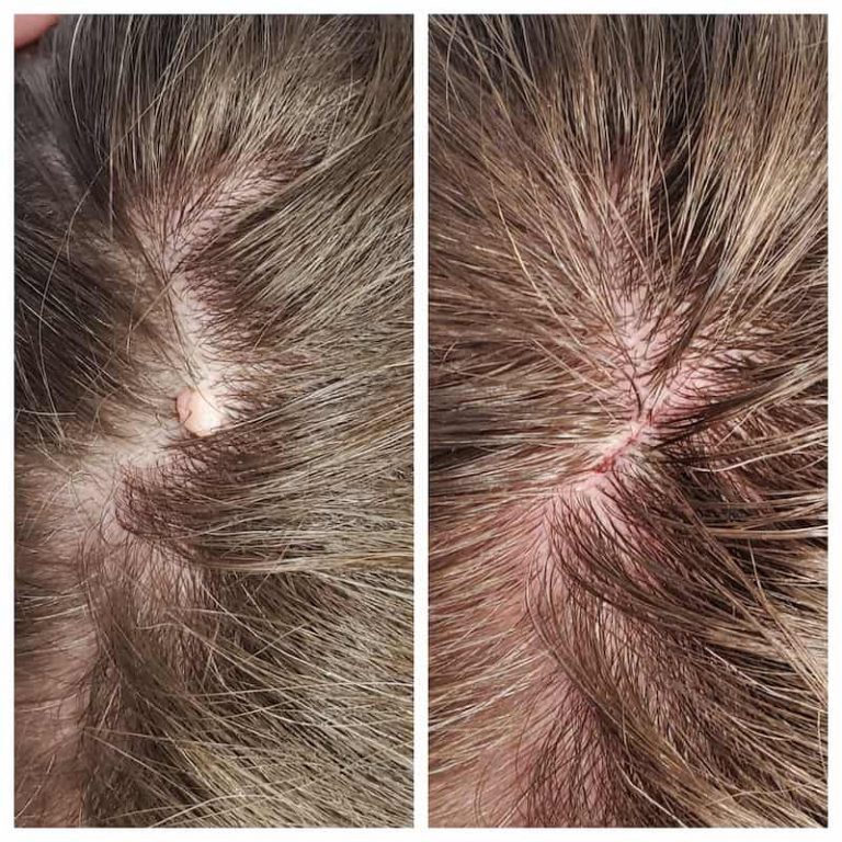 Mole Removal Before And After St Louis Dermatology Cosmetic Surgery