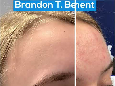 Forehead Acne Cure | St. Louis Acne Treatment