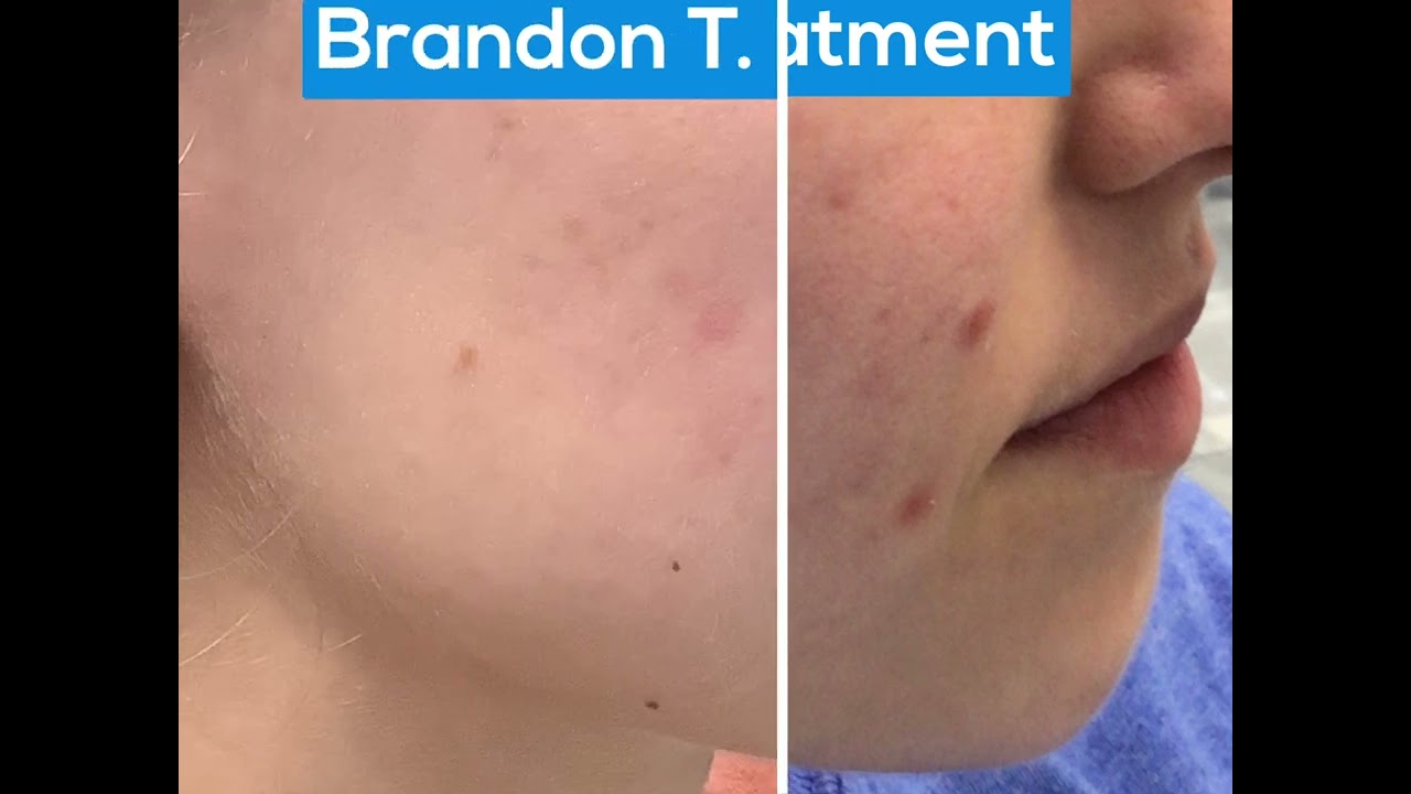 Acne Treatments | St. Louis Acne Cure | Dr. Brandon T. Beal
