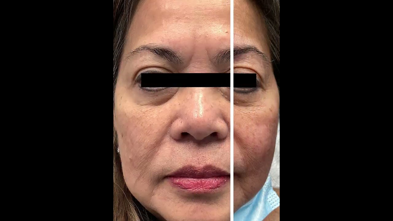 Comprehensive Facial Rejuvenation | Before & After | STL Dermatology & Cosmetic Surgery
