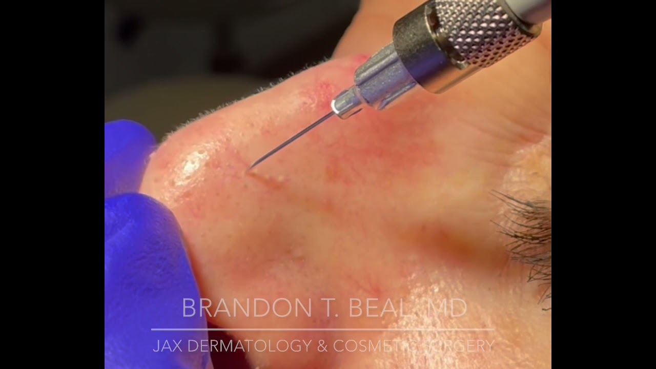Vein Treatments (Sclerotherapy) 2