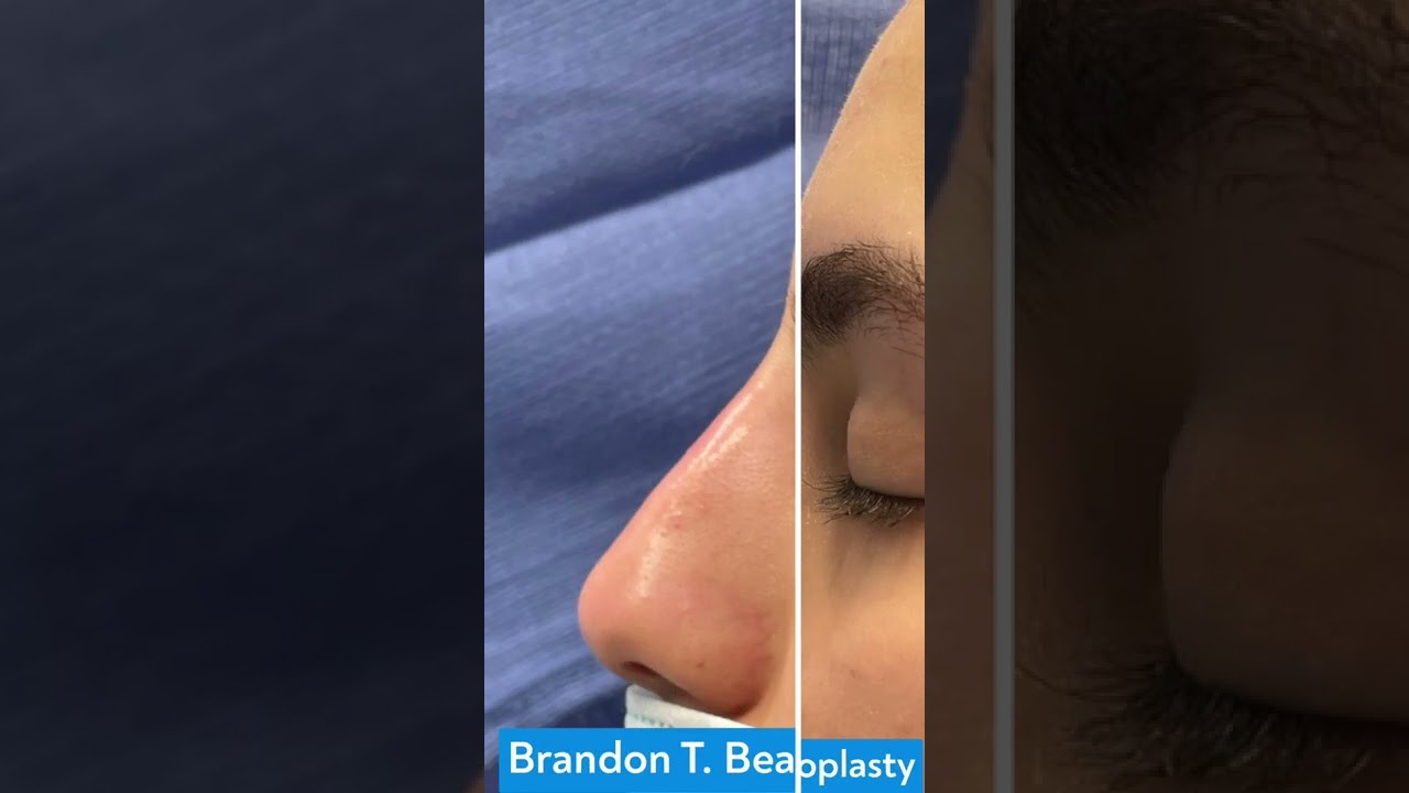Non Surgical Rhinoplasty | St Louis Dermatology & Cosmetic Surgery | Before and After