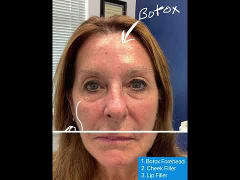 Natural Facial Rejuvenation with Fillers and Botox by Dr. Brandon Beal