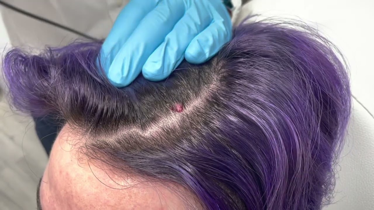 Cherry Angioma Removal | St. Louis Dermatology & Cosmetic Surgery
