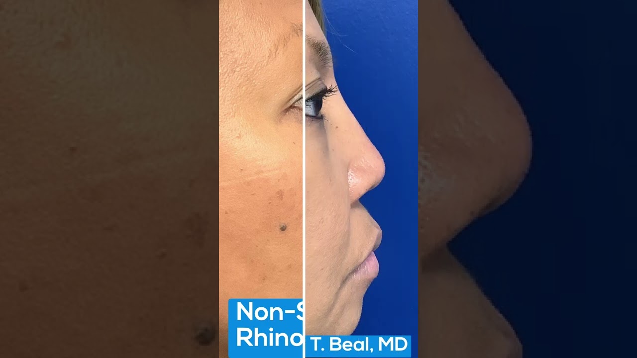 Non Surgical Rhinoplasty St. Louis | St. Louis Dermatology & Cosmetic Surgery