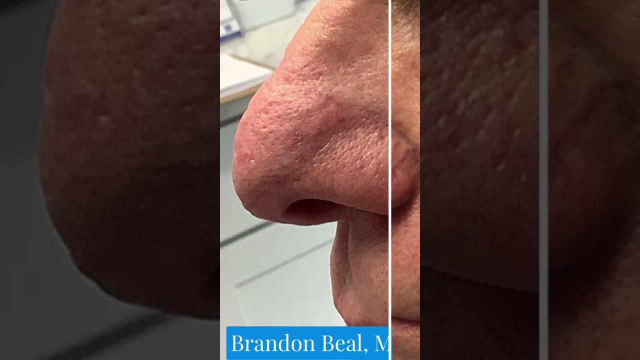 Treating Blood Vessels on the Side of a Patients Nose Before & After | St. Louis