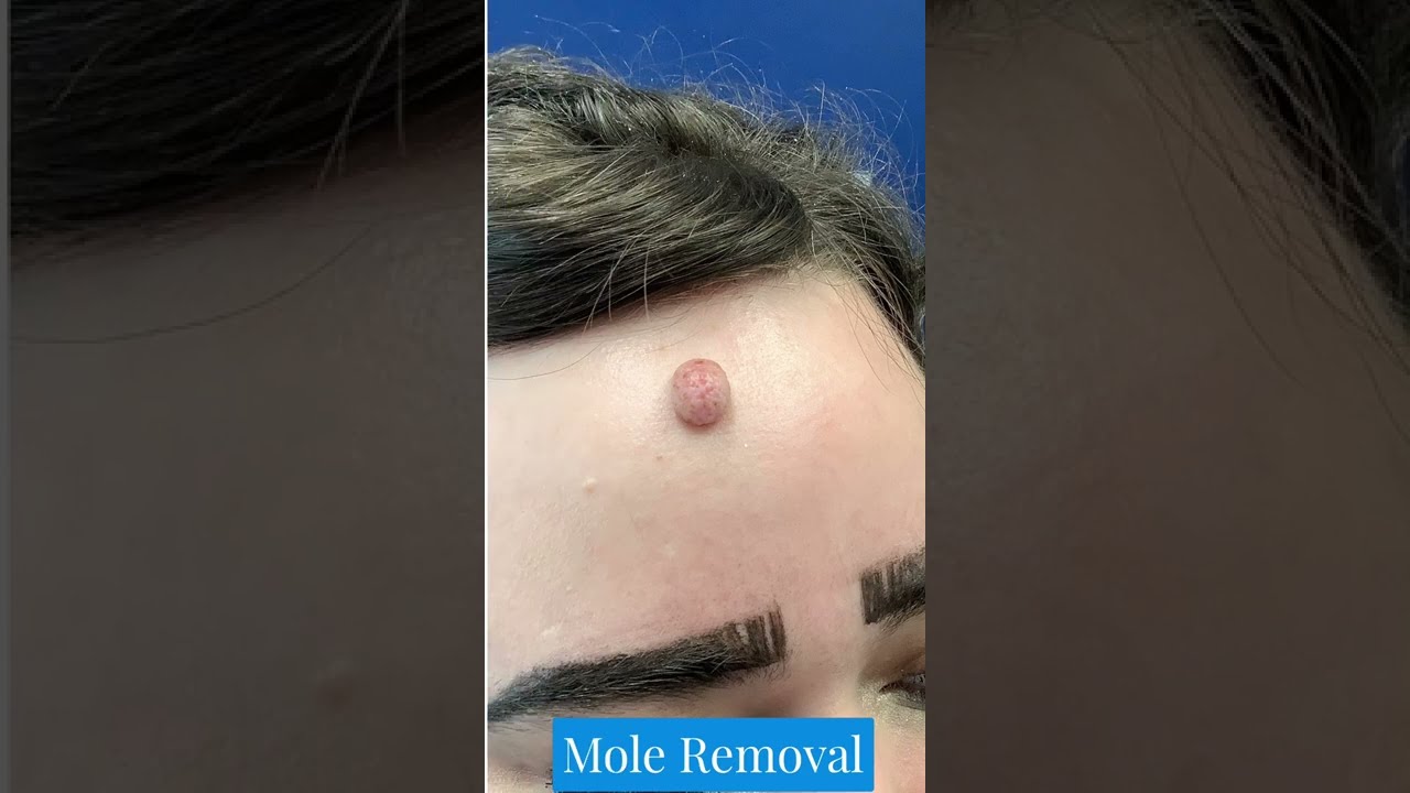 St. Louis Mole Removal | Mole Removal | Dr. Brandon T. Beal