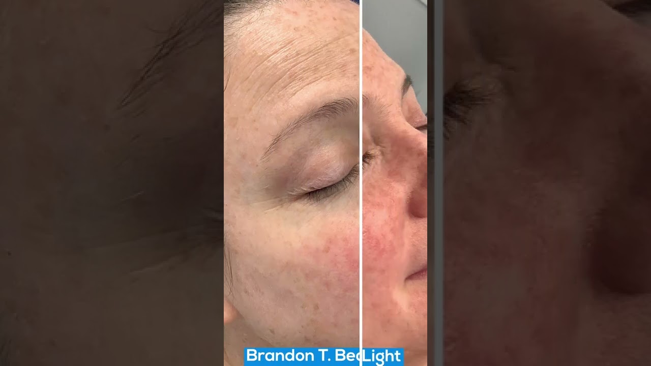 Blue Light Treatment for Brown Spots | St. Louis Dermatology & Cosmetic Surgery