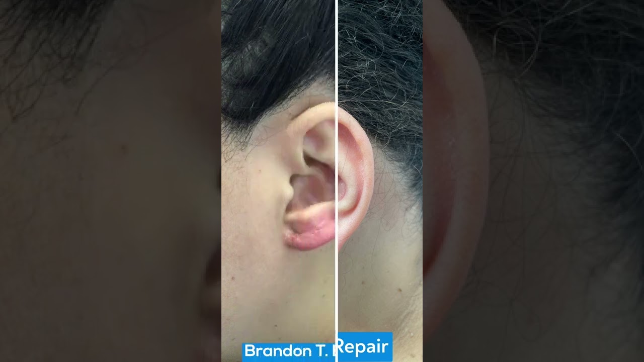 Earlobe Keloid Plastic Surgery Removal Before & After St. Louis