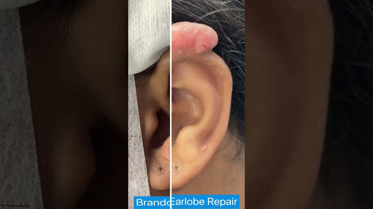 Recurrent Earlobe Keloid Removal St. Louis | Keloid Surgery | Large Ear Keloid