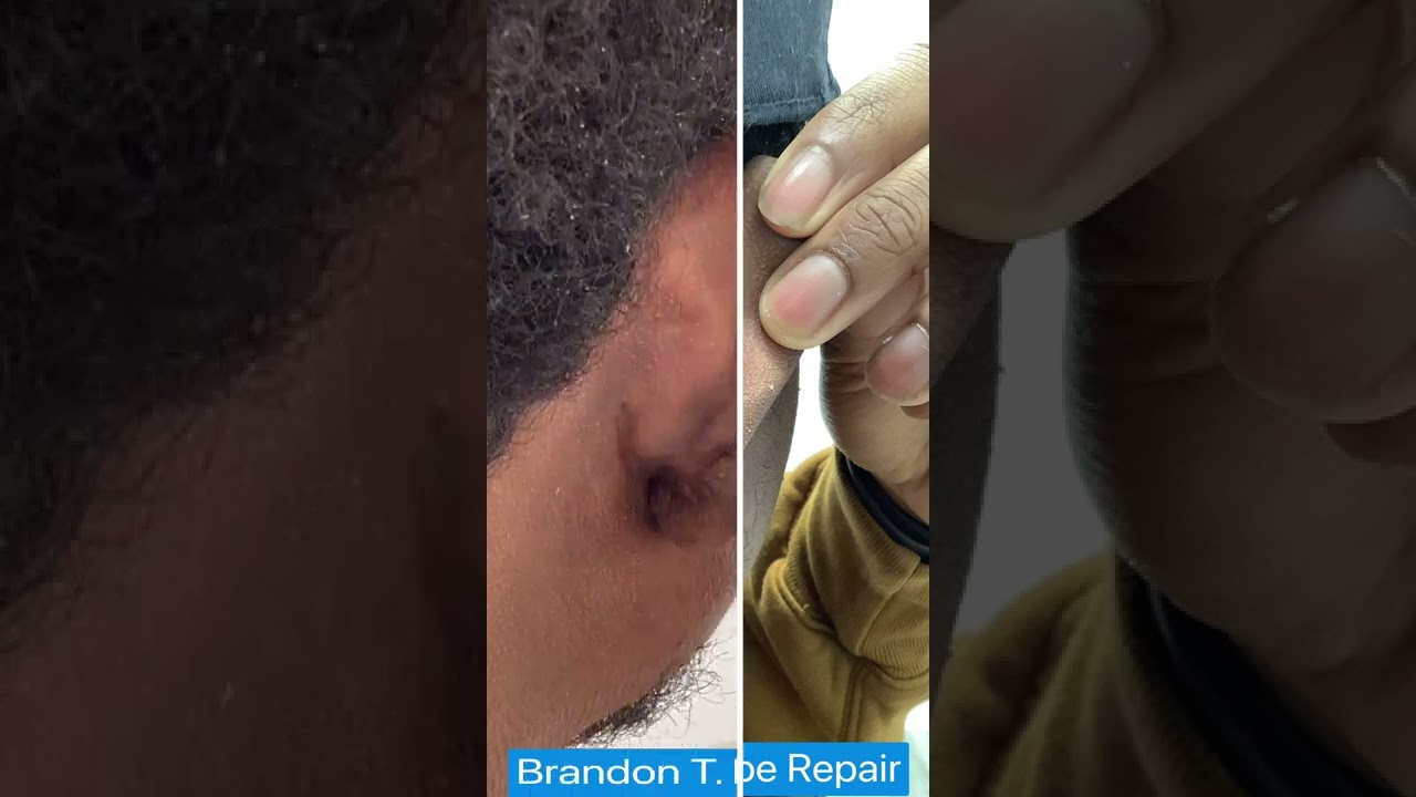 Earlobe Keloid Removal Before & After St. Louis