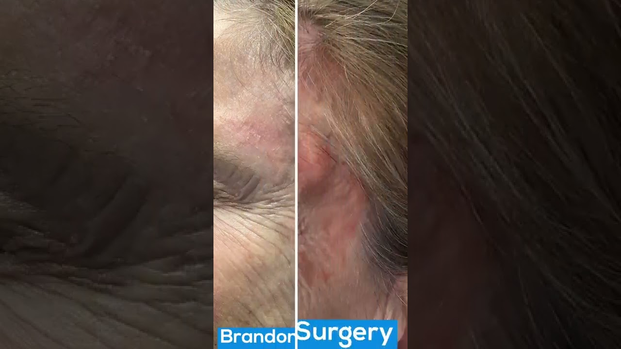 Mohs Surgery on a Patient's Face Before & After | St. Louis Dermatology & Cosmetic Surgery