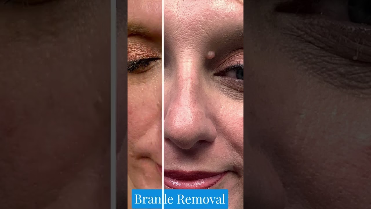 Eyelid Mole Removal St. Louis | STL Dermatology & Cosmetic Surgery