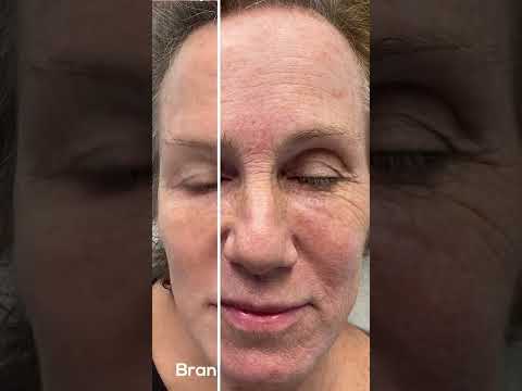 Facial Rejuvenation St. Louis | Resurfacing, Botox, & Filler | Natural Cosmetic Results