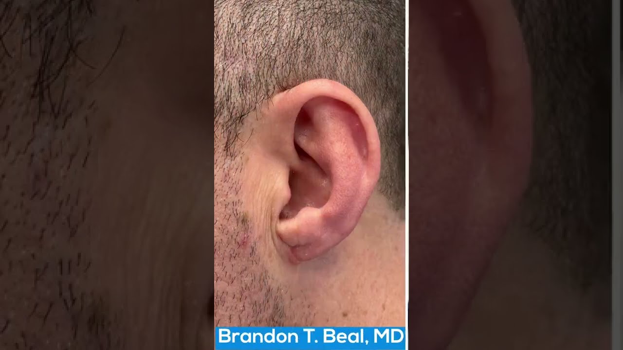 Gauged Earlobe Repair Before & After St. Louis | Earlobe Plastic Surgery