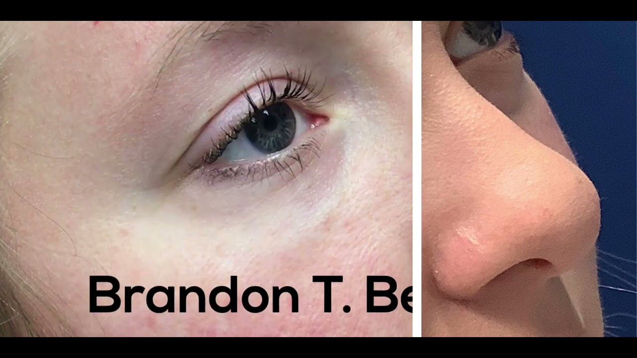 Dark Circles Under Eye Filler Before & After St. Louis, MO