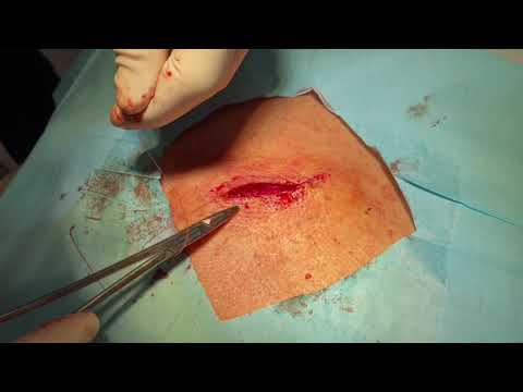 Cyst Removal Jacksonville Dr. Beal