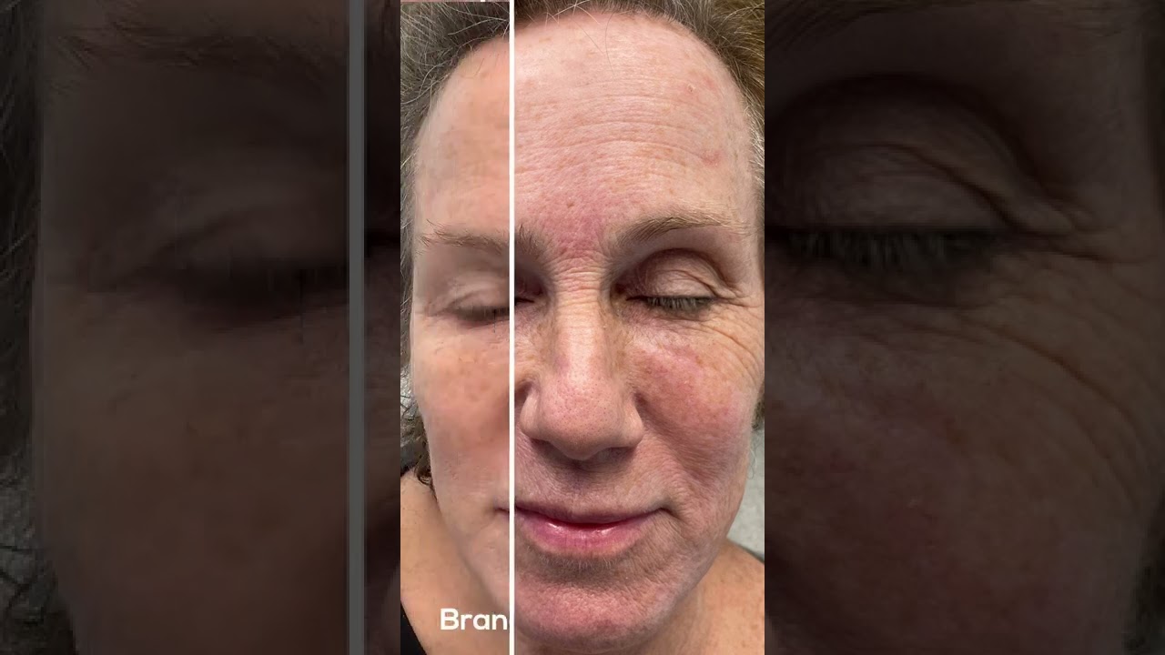 Facial Rejuvenation St. Louis | Resurfacing, Botox, & Filler | Natural Cosmetic Results