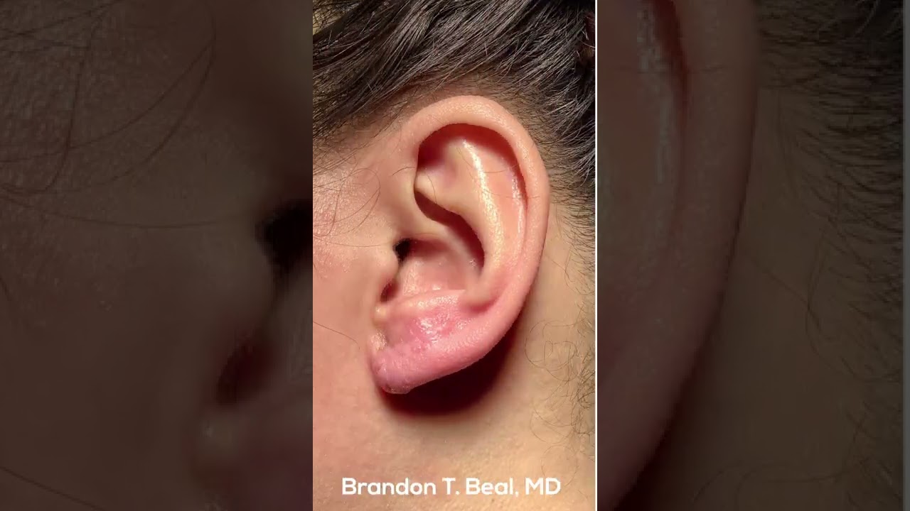 Ear Keloid Removal and Repair Before & After