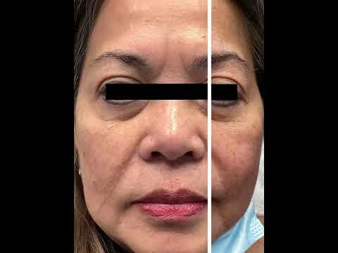 Comprehensive Facial Rejuvenation | Before & After | STL Dermatology & Cosmetic Surgery