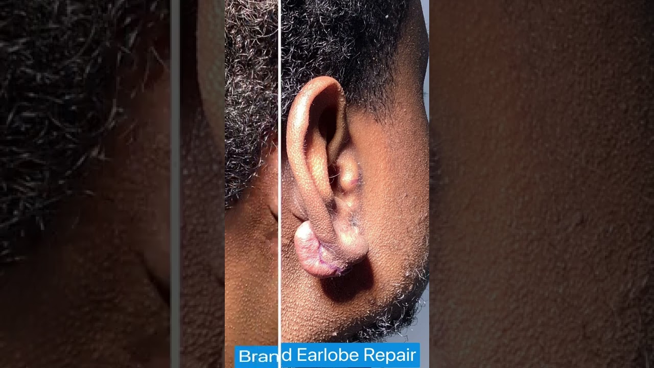 Ear Keloid Removal | Dr. Brandon Beal | St. Louis Dermatology & Cosmetic Surgery