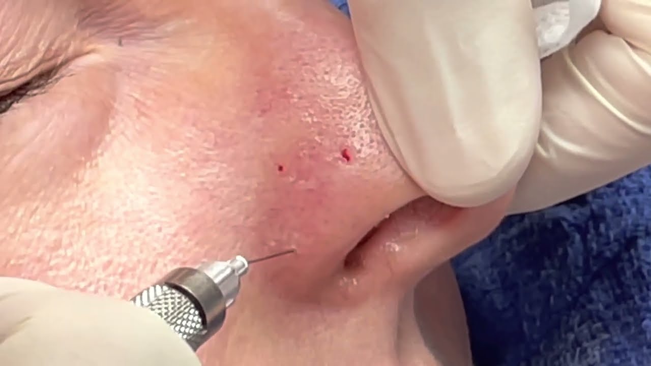 Nose Enlarged Blood Vessel Treatment  | Telangiectasia | Dr. Brandon Beal