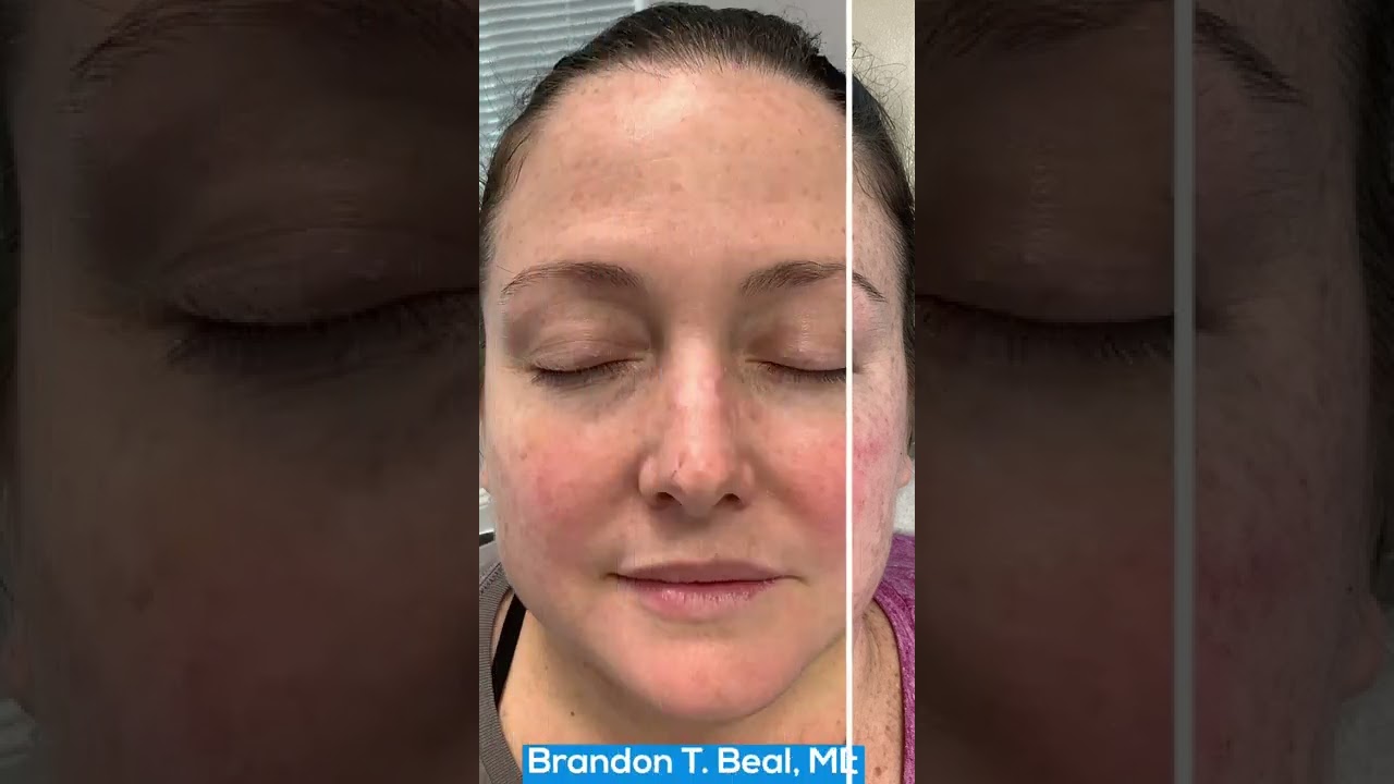 Blue Light Treatment Before & After | Treating Age Spots | Painless Blue Light Treatment St. Louis