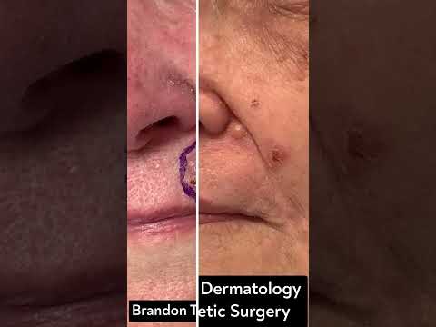 Basal Cell Carcinoma Tumor Before & After | St. Louis Dermatology & Cosmetic Surgery