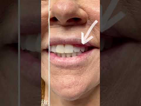 Lip Reduction Before and After to Unveil a Wider Smile - STL Dermatology & Cosmetic Surgery