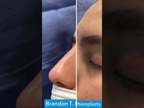 Dorsal Nasal Hump Correction | St. Louis, MO | Liquid Rhinoplasty St. Louis