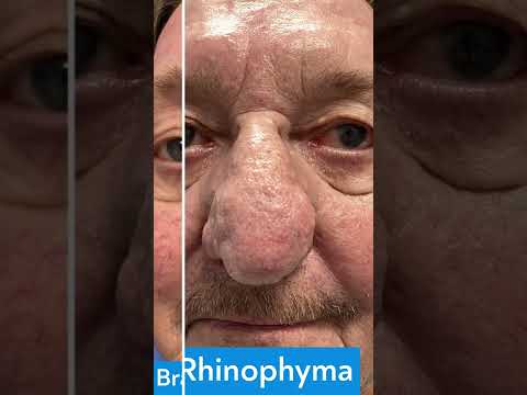 Rhinophyma Treatment Before and After | St. Louis Dermatology & Cosmetic Surgery