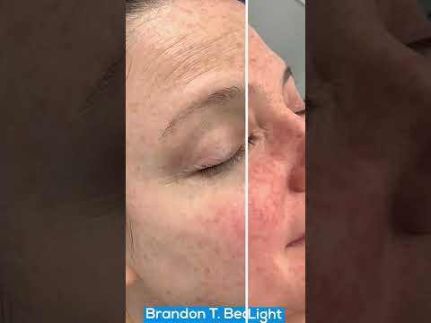 Blue Light Treatment for Brown Spots | St. Louis Dermatology & Cosmetic Surgery