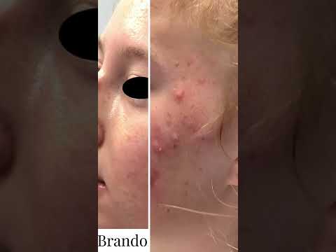 Acne Treatment Before & After | Acne CURE | St. Louis Dermatology & Cosmetic Surgery
