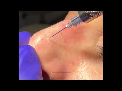 Treatment for Telangiectasia (Spider Veins) on the Nose | Dr. Brandon Beal