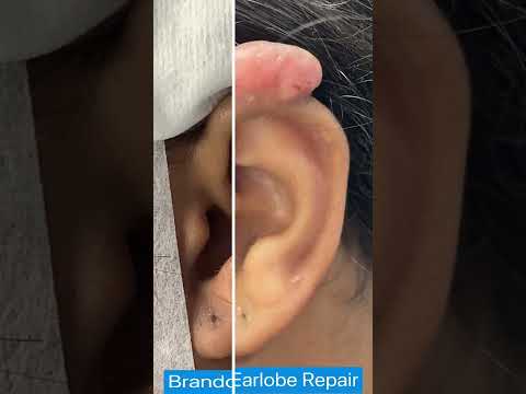 Recurrent Earlobe Keloid Removal St. Louis | Keloid Surgery | Large Ear Keloid