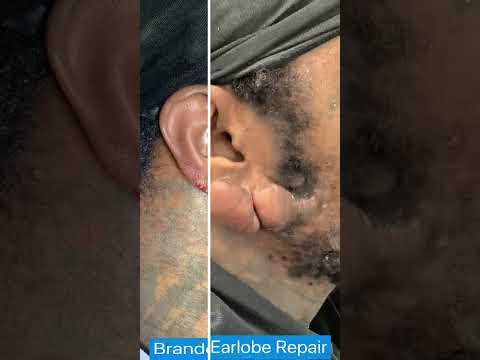 Large Earlobe Keloid Removed Before & After, St. Louis | St. Louis Dermatology & Cosmetic Surgery