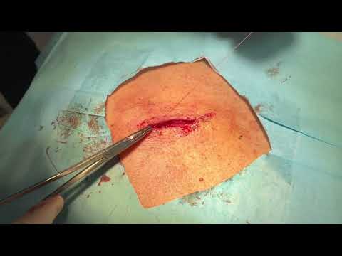 Cyst Removal | St. Louis Dermatology & Cosmetic Surgery | Cyst Removal St. Louis, MO