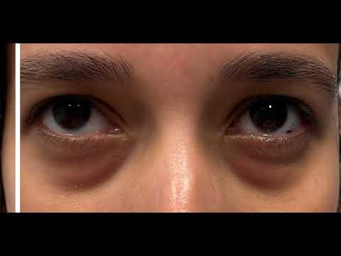 Treat Dark Under Eye Circles | Tear Trough Filler Before & After St. Louis