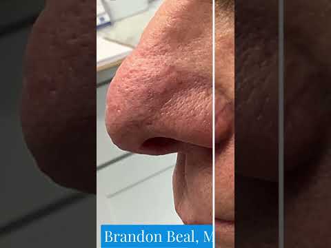 Treating Blood Vessels on the Side of a Patients Nose Before & After | St. Louis