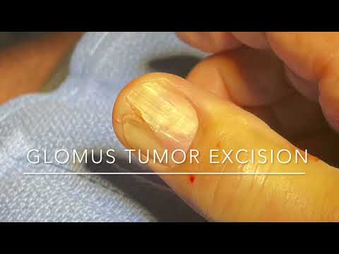 Glomus Tumor Removal St. Louis | Nail Surgery | Painful Fingernail Cyst