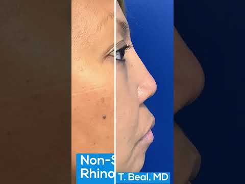 Non Surgical Rhinoplasty St. Louis | St. Louis Dermatology & Cosmetic Surgery