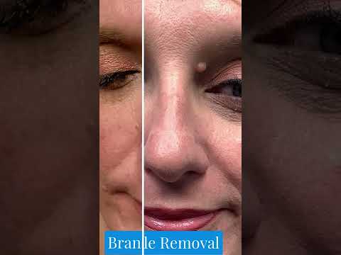 Eyelid Mole Removal St. Louis | STL Dermatology & Cosmetic Surgery
