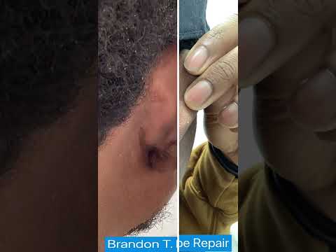 Earlobe Keloid Removal Before & After St. Louis