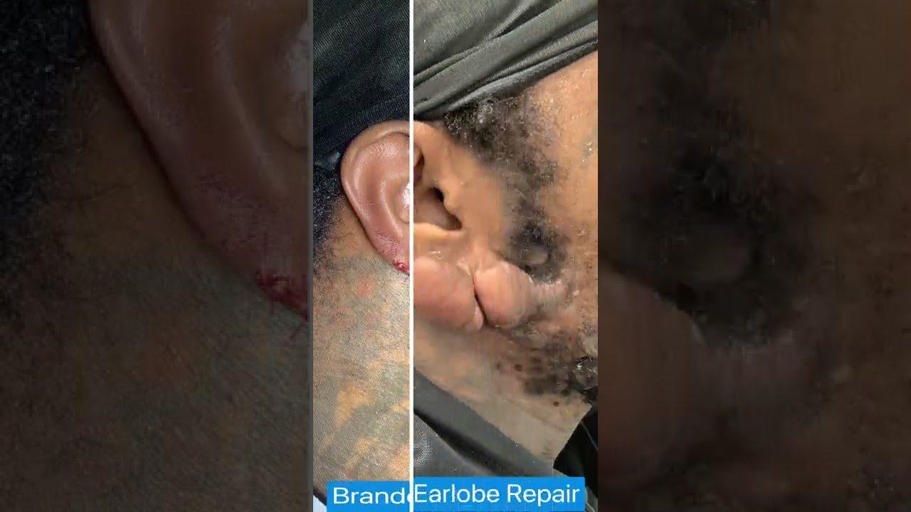 Large Earlobe Keloid Removed Before & After, St. Louis | St. Louis Dermatology & Cosmetic Surgery
