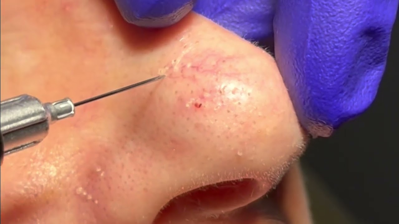 Telangiectasia Treatment on the Nose by Dr. Brandon Beal