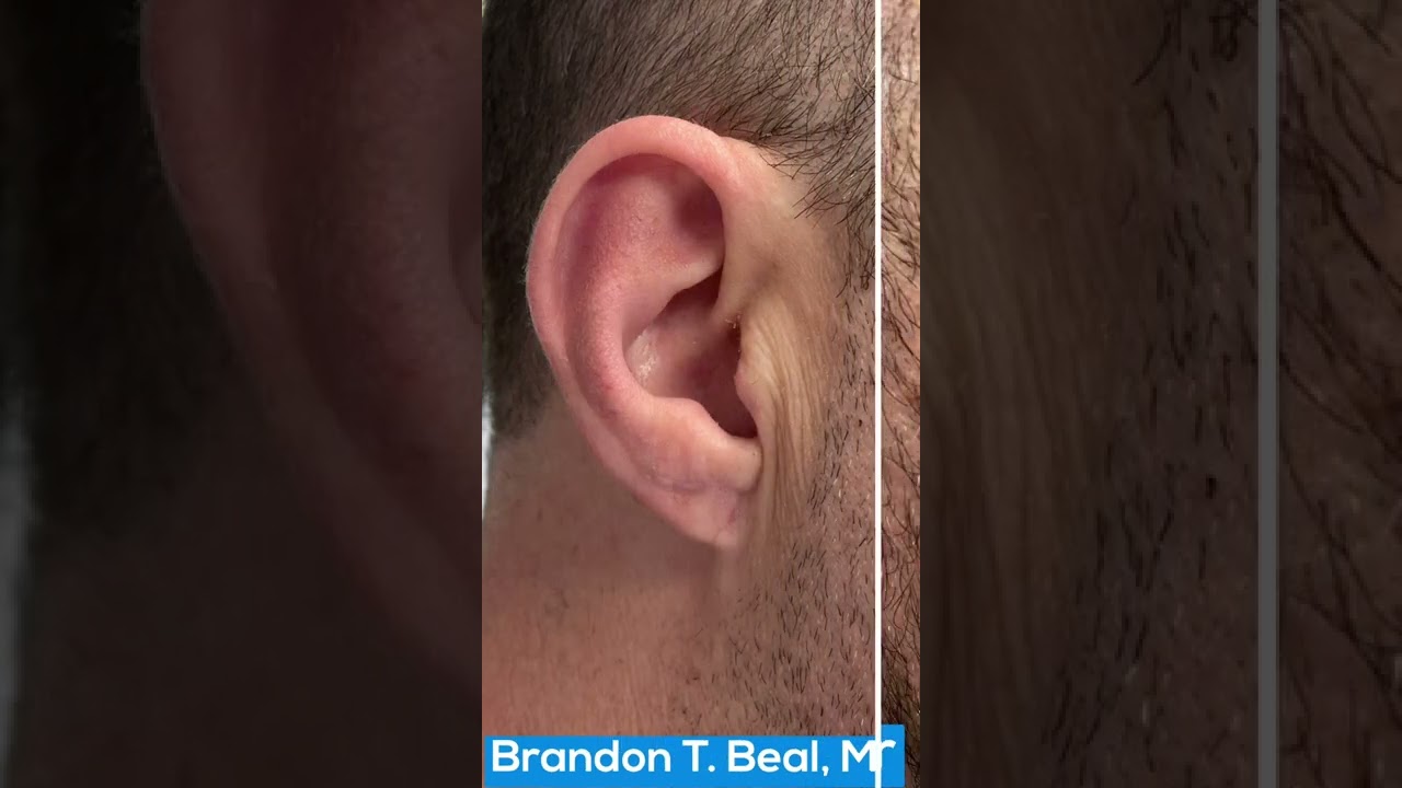 Large Gauged Earlobe Repair Before & After St. Louis | St. Louis Dermatology & Cosmetic Surgery
