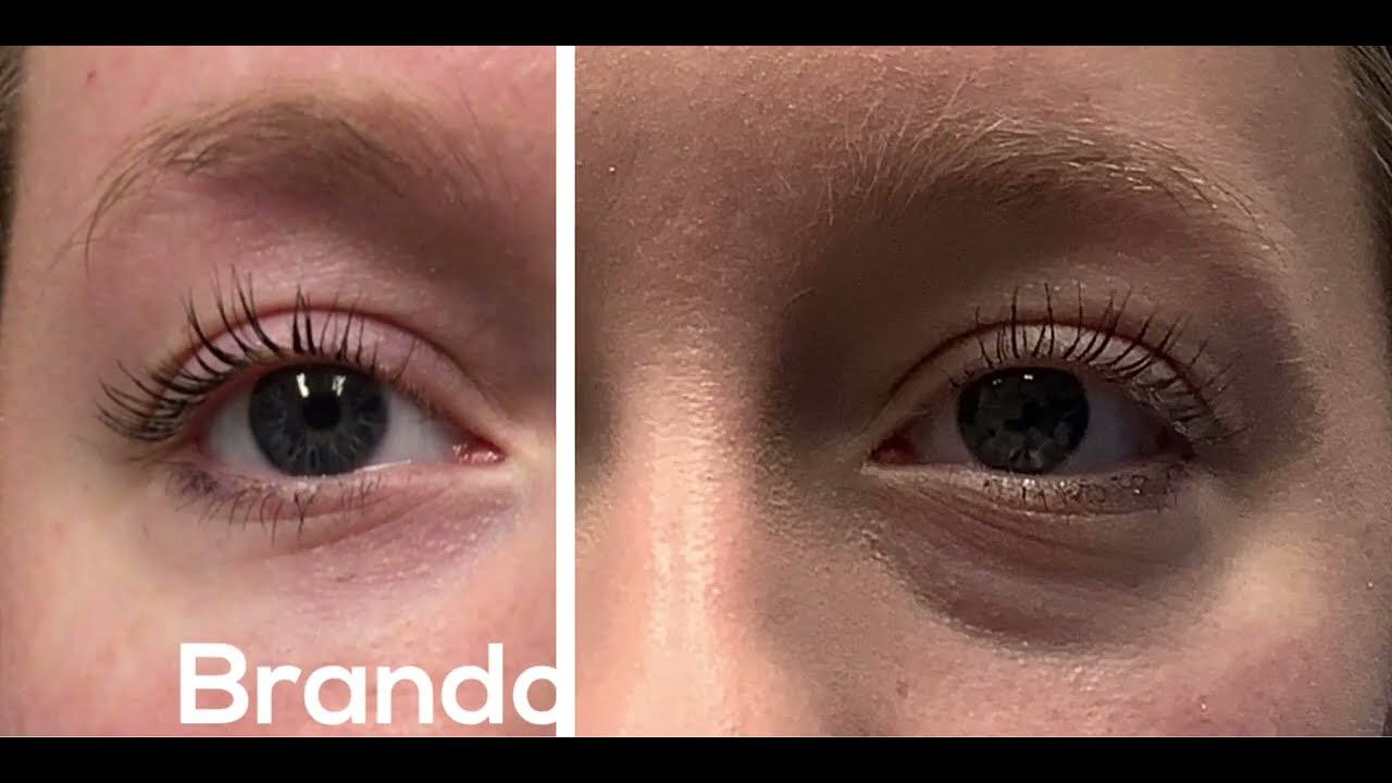 Tear Trough Filler St. Louis (Correct Dark Under Eye Circles) - Before & After with Amazing Results