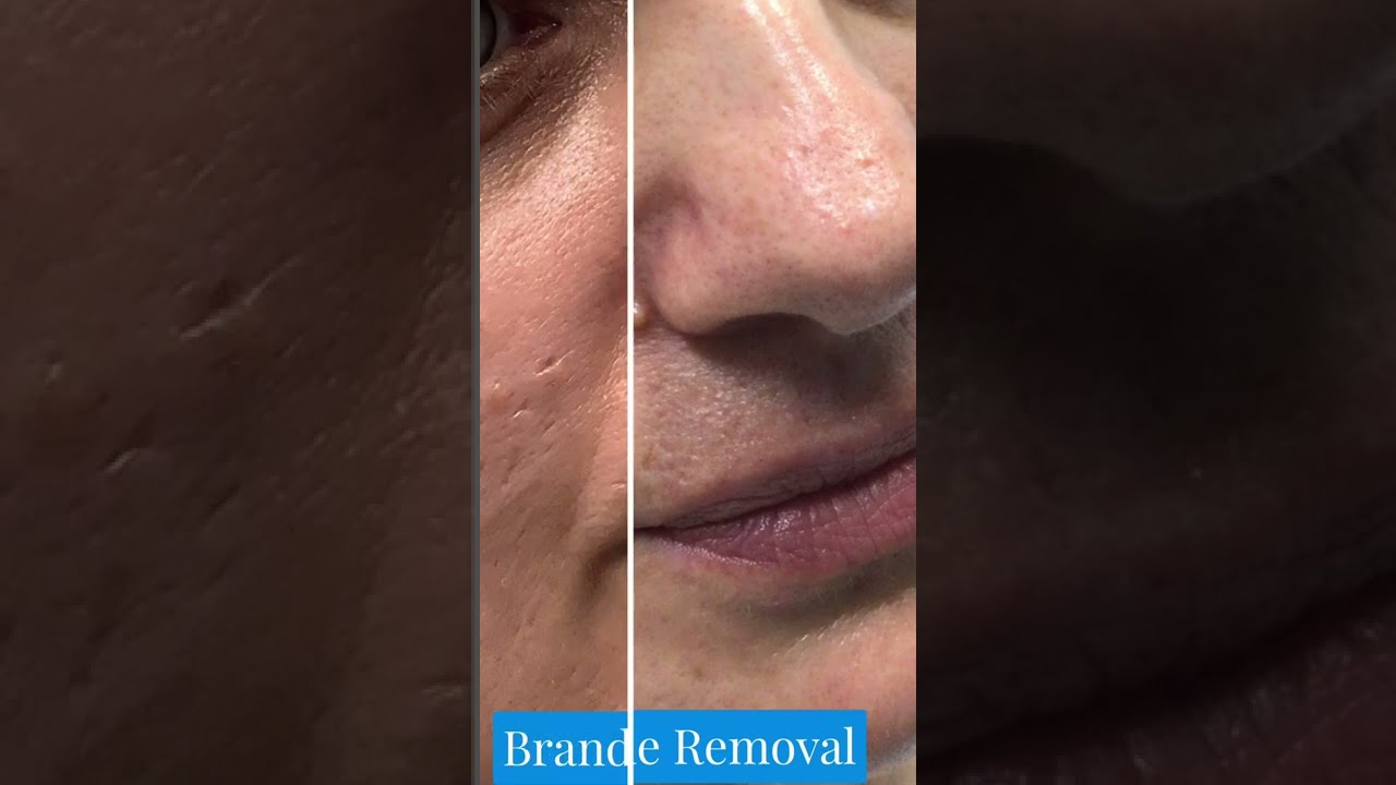 Scarless Mole Removal | St. Louis Mole Removal | STL Dermatology & Cosmetic Surgery