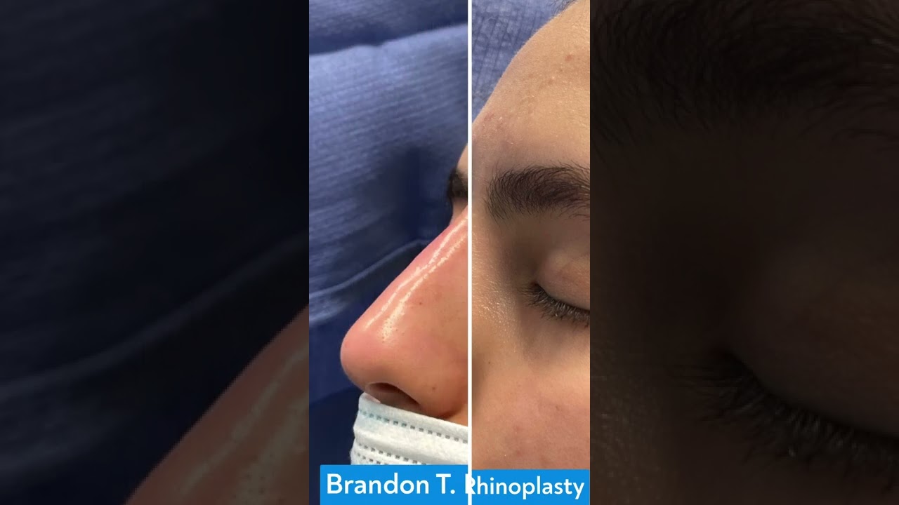 Dorsal Nasal Hump Correction | St. Louis, MO | Liquid Rhinoplasty St. Louis