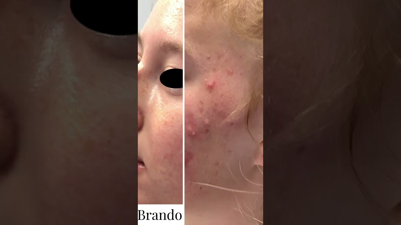 Acne Treatment Before & After | Acne CURE | St. Louis Dermatology & Cosmetic Surgery